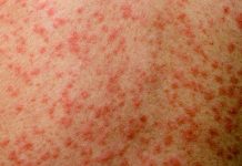 Measles outbreak at 704
